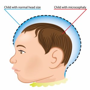 microcephaly-baby-heads
